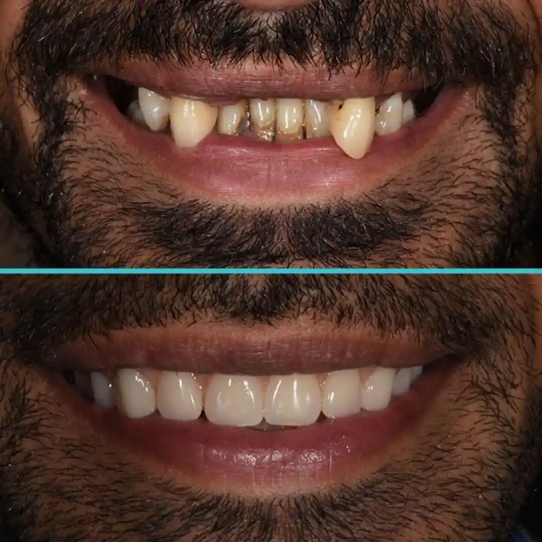 Partial Denture - Before and After Result