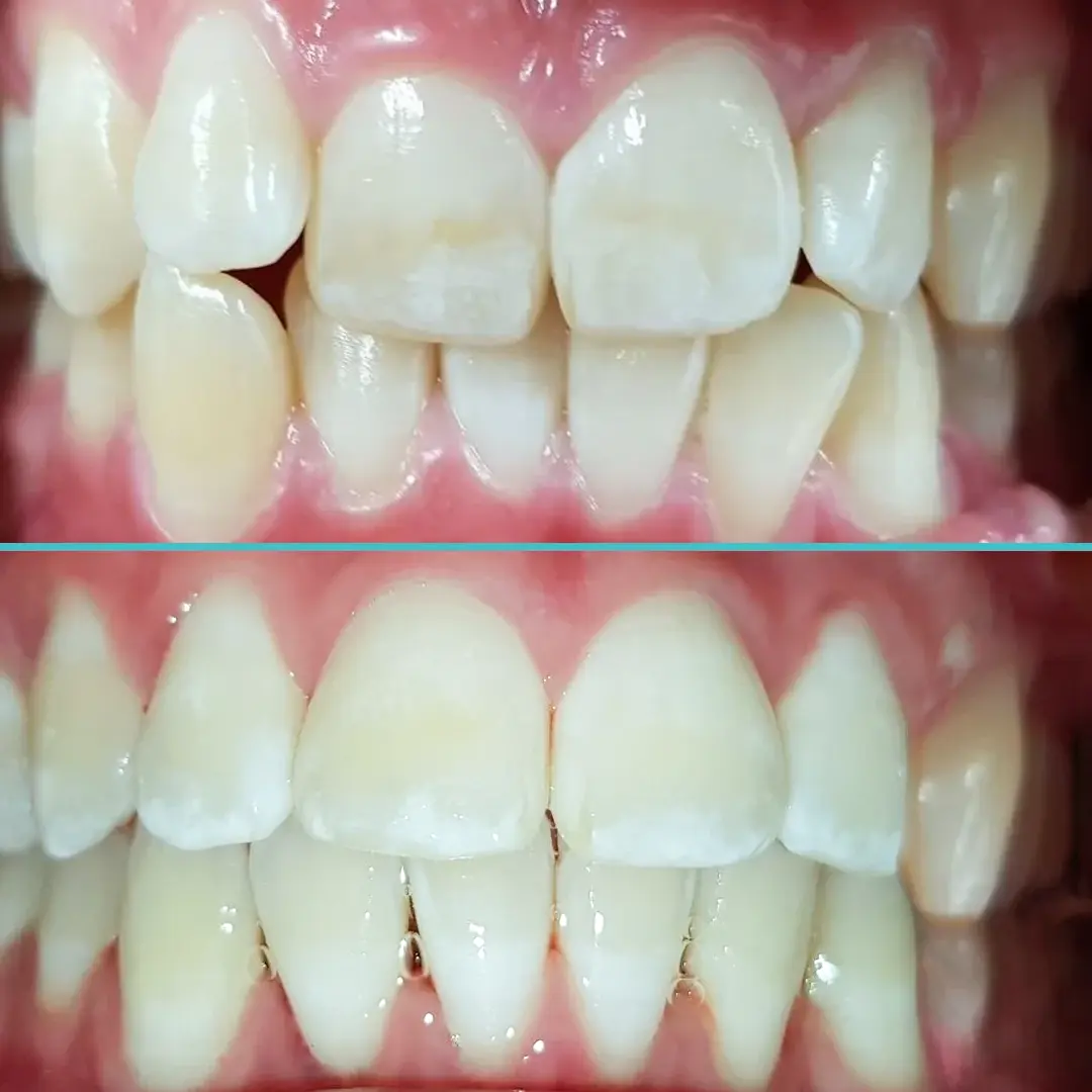 Orthodontics Teeth Straightening - Before and After Result