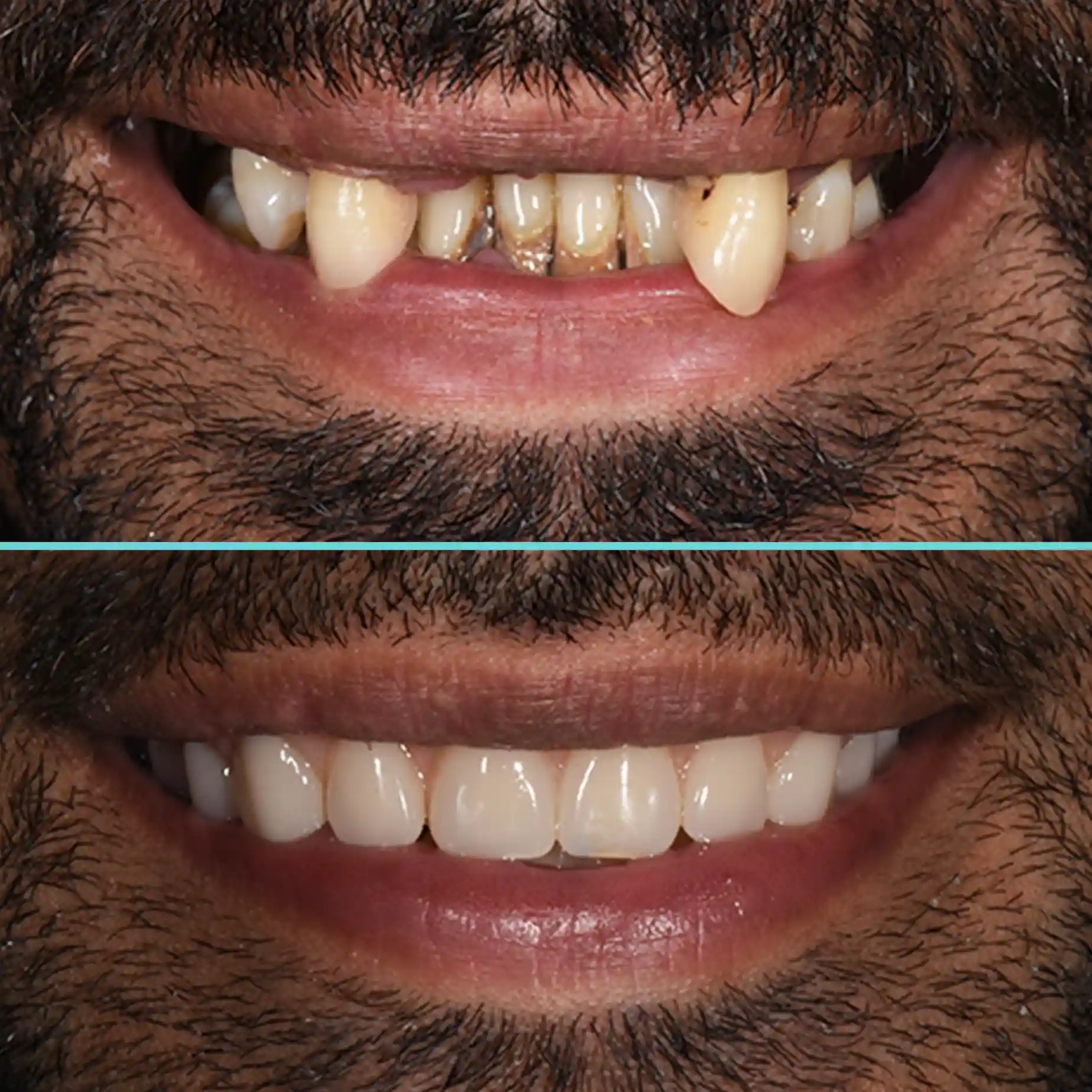 Partial Denture - Before and After Result