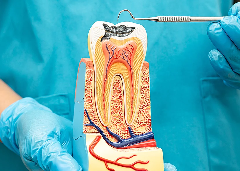 A dental model showing a cross-section of a tooth with a cavity. Gloved hands hold a dental tool pointing at the cavity. Educational context.