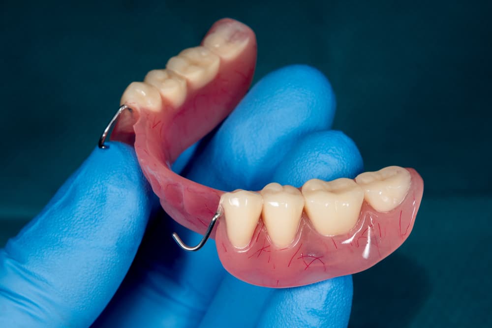 Acrylic Partial Dentures