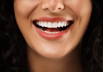 Teeth Whitening Options for a Brighter Smile in Melbourne