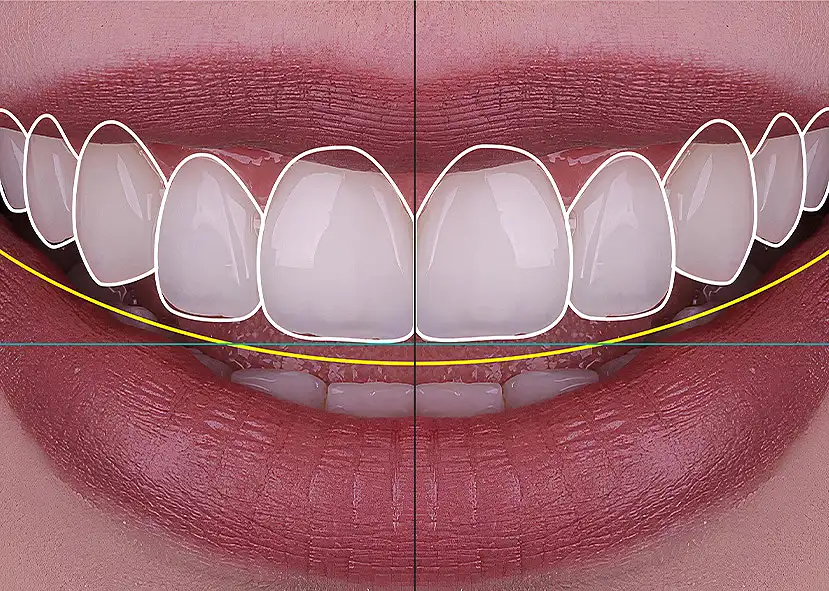 Close-up of a smile showing white teeth with outlined shapes indicating ideal alignment. A yellow curve shows the desired curvature, with a focus on symmetry.