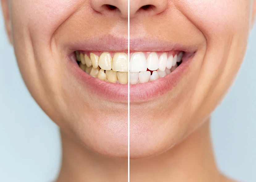 Split image of a smile: left side shows yellowed teeth, right side shows whitened teeth, demonstrating a teeth-whitening transformation.
