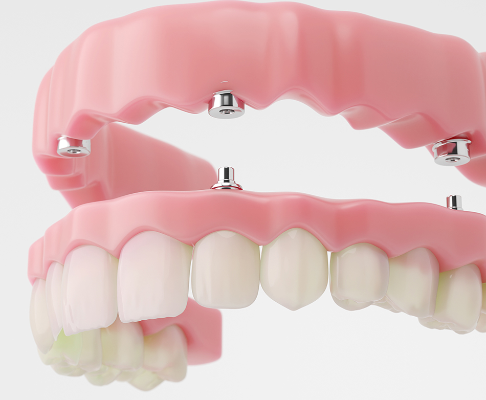 Implant-supported dentures consultation and treatment planning