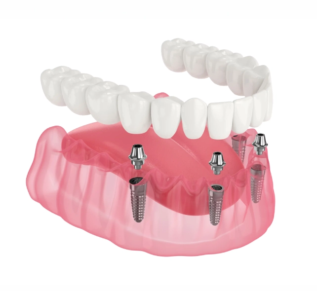 Dental bridge model on a clear stand, displaying six realistic teeth with gum detail on a light gray surface, reflecting clinical precision.