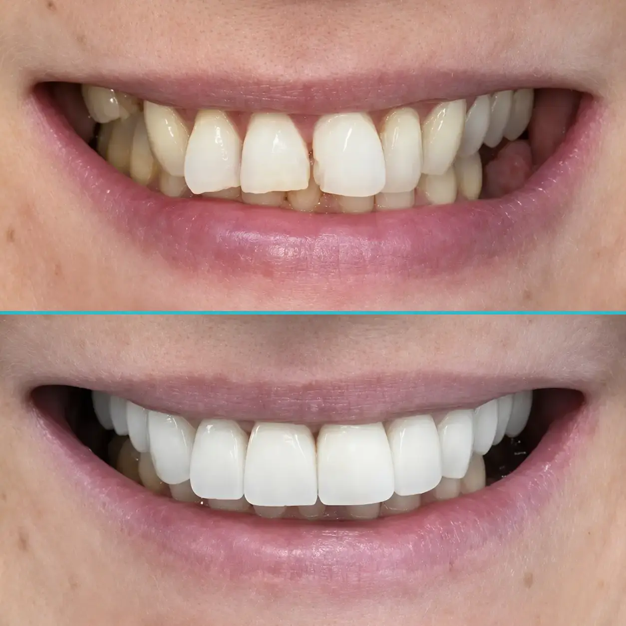 Crowns Before and After Result
