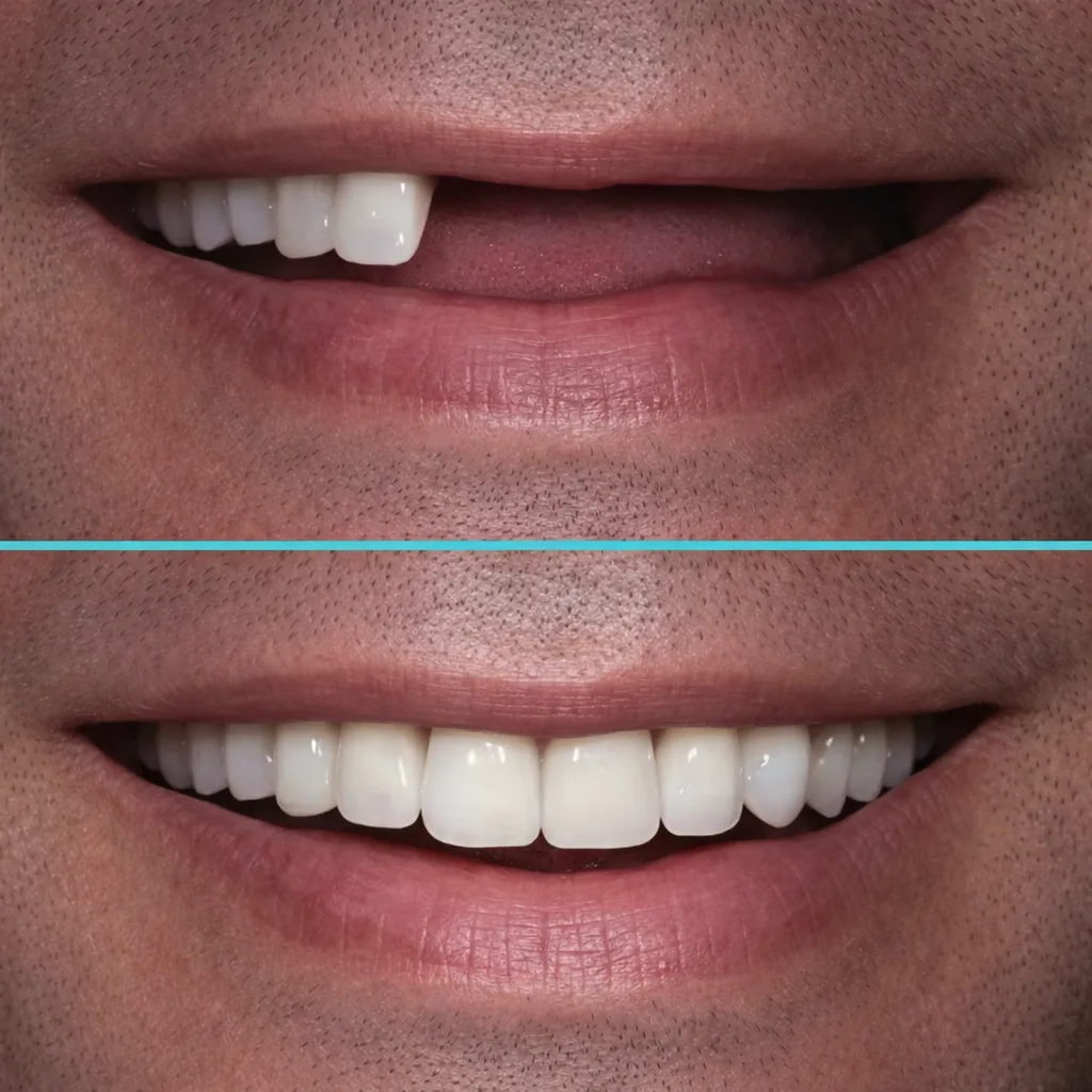 Acrylic Dentures Before After Case Result