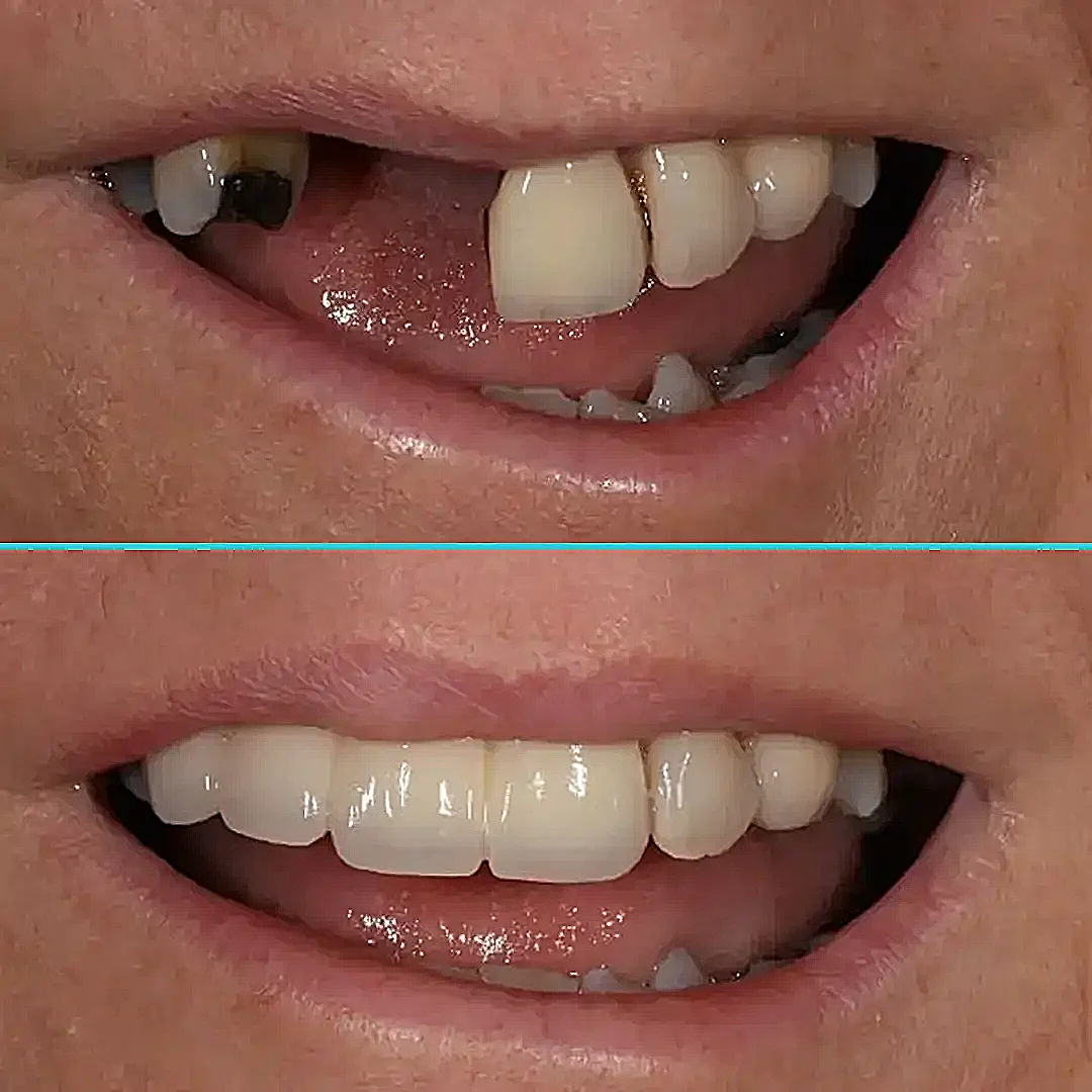 Crown and Bridge Before and After Result
