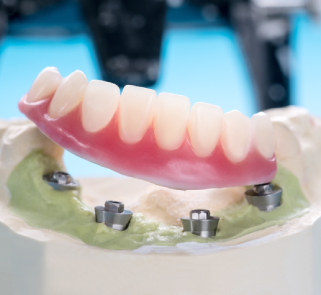 implant supported overdenture dental model abutments