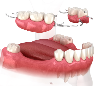 removable-cast-partial-denture-mandibular-arch